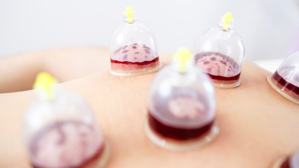 hijama procedure with plastic suction cups containing small amounts of blood on a patient's back